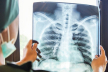 На Тернопільщині за два місяці виявили 50 хворих на туберкульоз