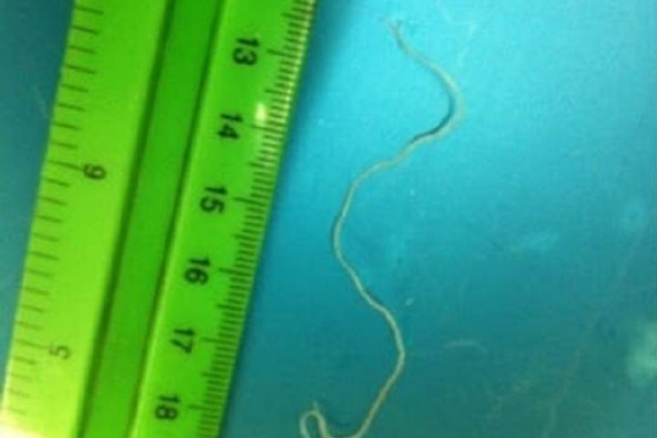 Львівські медики витягли з ока трирічної дівчинки 10-сантиметрового паразита