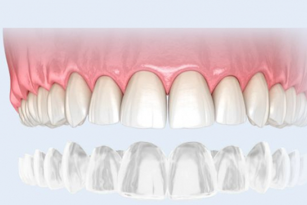 Вирівнювання зубів елайнерами: чому варто обрати даний спосіб