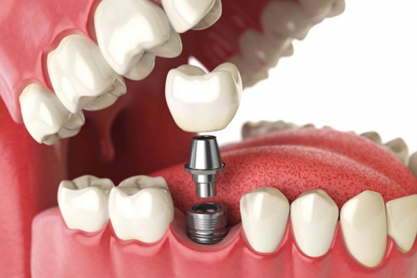 Все, що потрібно знати про Імплантацію зубів: Комплексний путівник